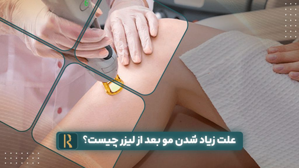 علت زیاد شدن مو بعد از لیزر چیست؟ بررسی کامل