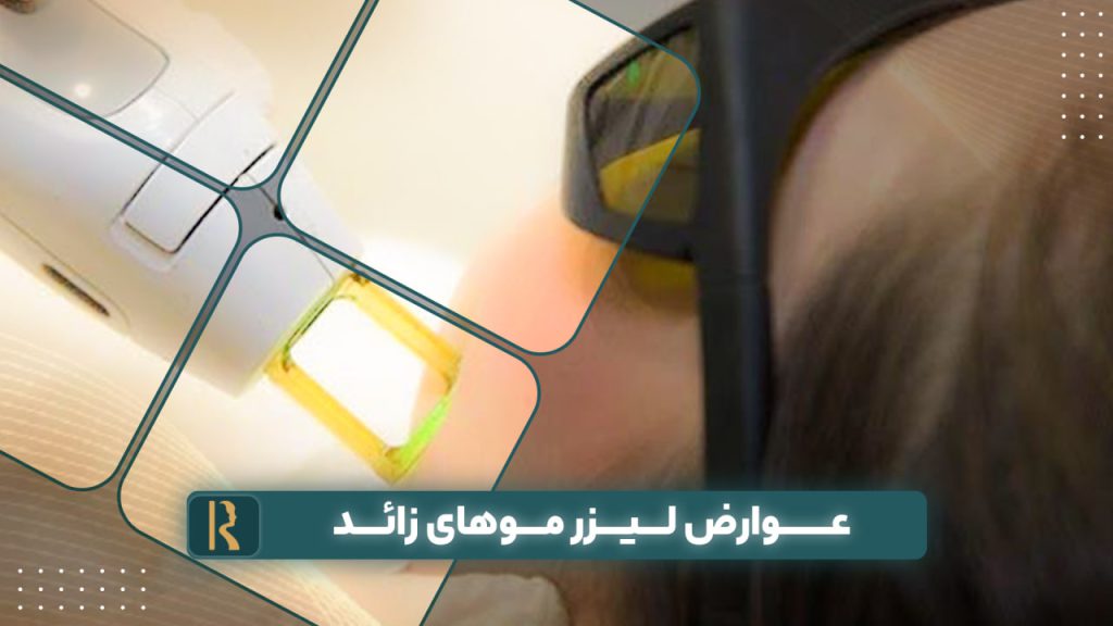 عوارض لیزر موهای زائد