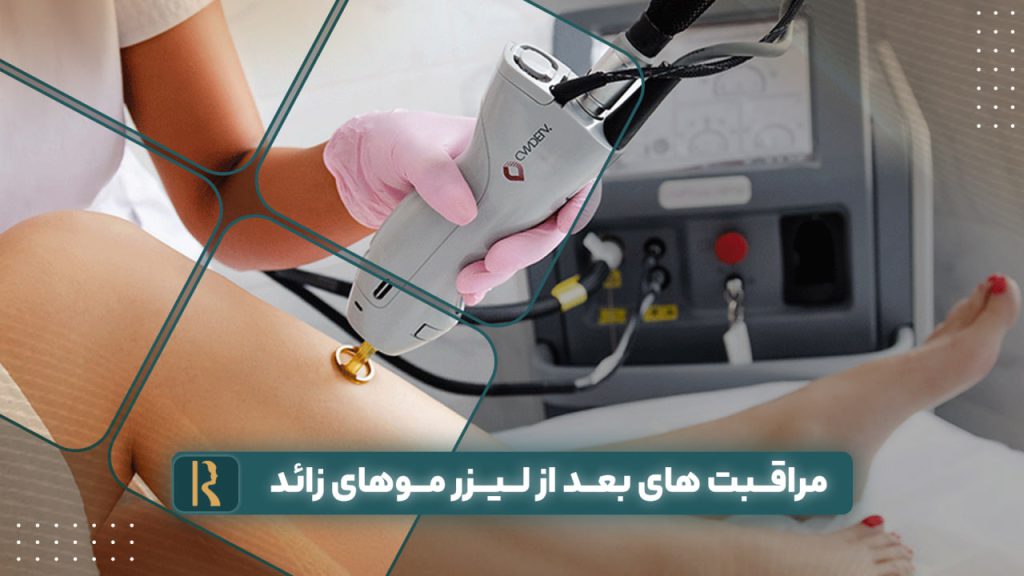 مراقبت های بعد از لیزر موهای زائد